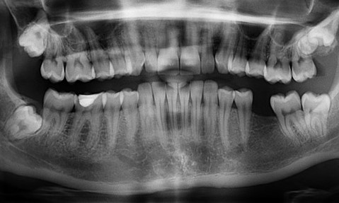 Zdjęcie pantomograficzne pokazuje układ zębów