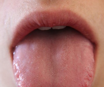 Usta - suchość w ustach to problem bolesny i niebezpieczny