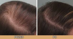 mezoterapia mezoterapia